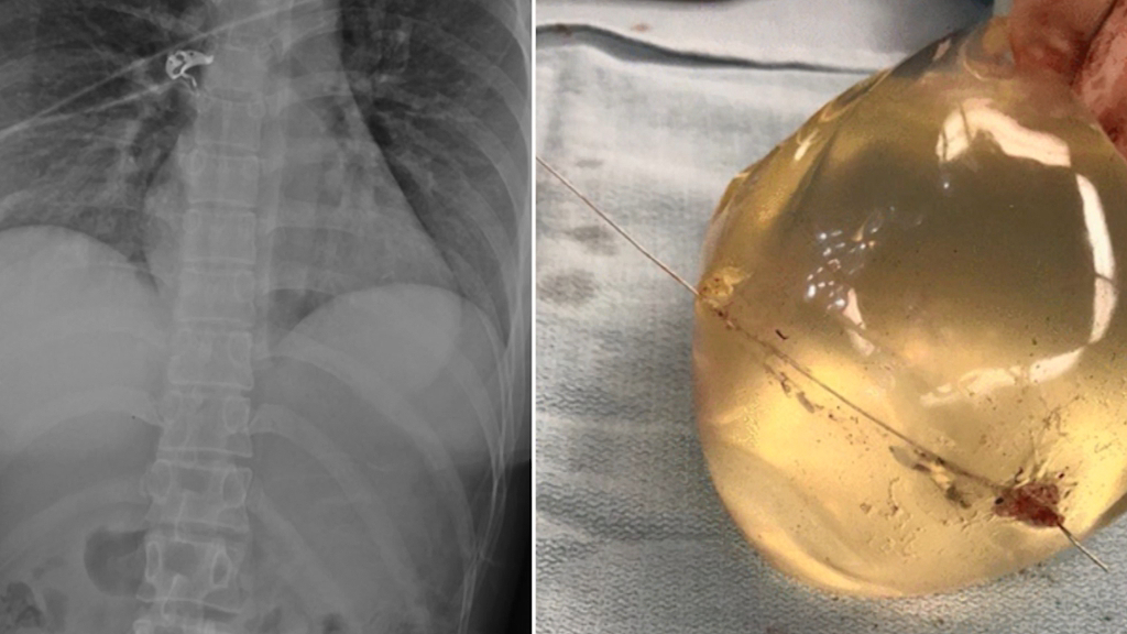 Woman's breast implant deflects bullet, saving her life
