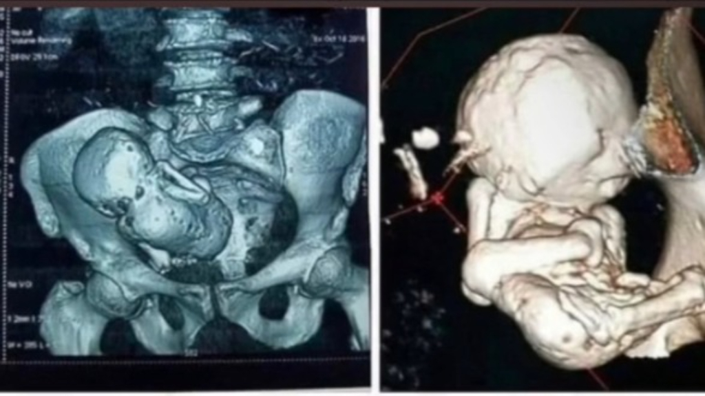 Woman's 35 year-old calcified fetus shocks TikTok