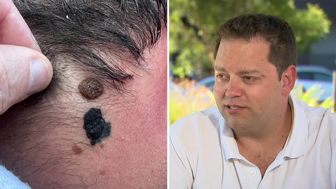 Homeowner saves tradie's life after spotting suspicious mole