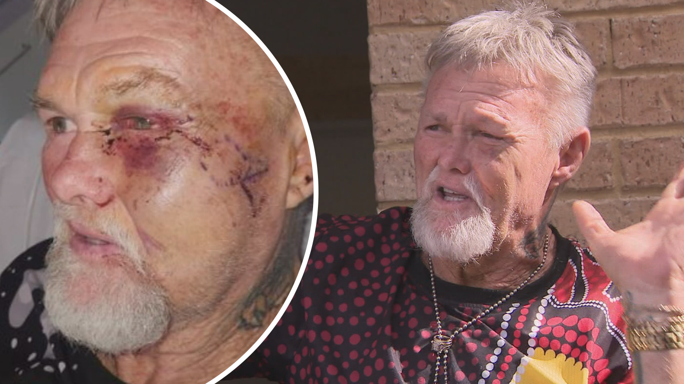 Perth grandfather needed metal plates in face after alleged bashing
